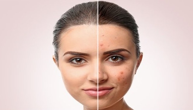 Acne behandeling tips